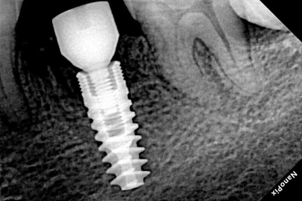 Alef implant bone loss minimize